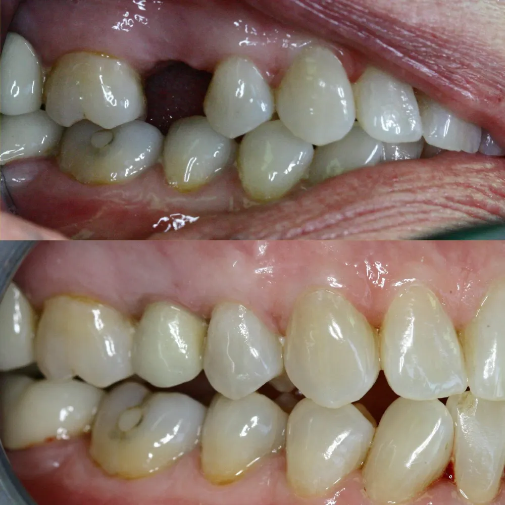 Side-by-side before and after of restored molars and missing tooth.